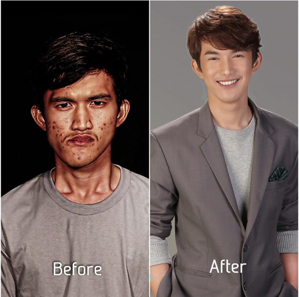Ngoài ra, anh còn được phẫu thuật rán và mí mắt cũng như tiêm botox để khắc phục tình trạng chảy nước dãi, điều trị da để loại bỏ các đốm đen.